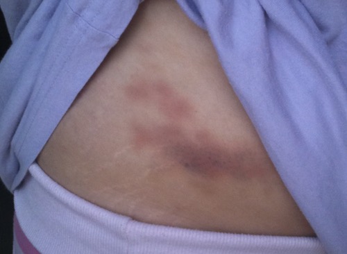 Image result for bruises