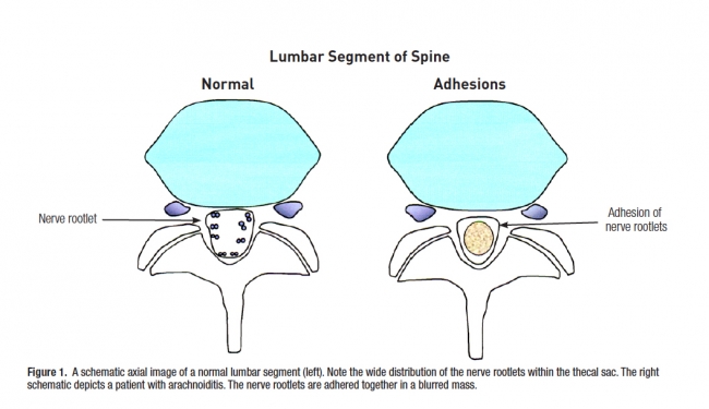 Image result for arachnoiditis