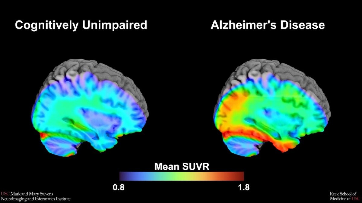 brain scans from USC Stevens alzheimer's study on Tau PET scans