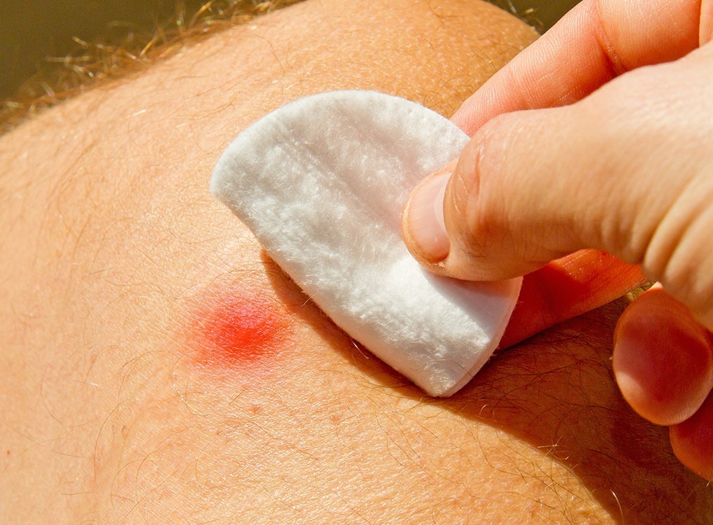 Bee Sting Bee Sting Does to Body