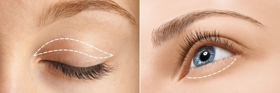 Cosmetic Eyelid Surgeries | Blepharoplasty – Eyelid Surgery For A Fresher, Younger Look | Her Beauty