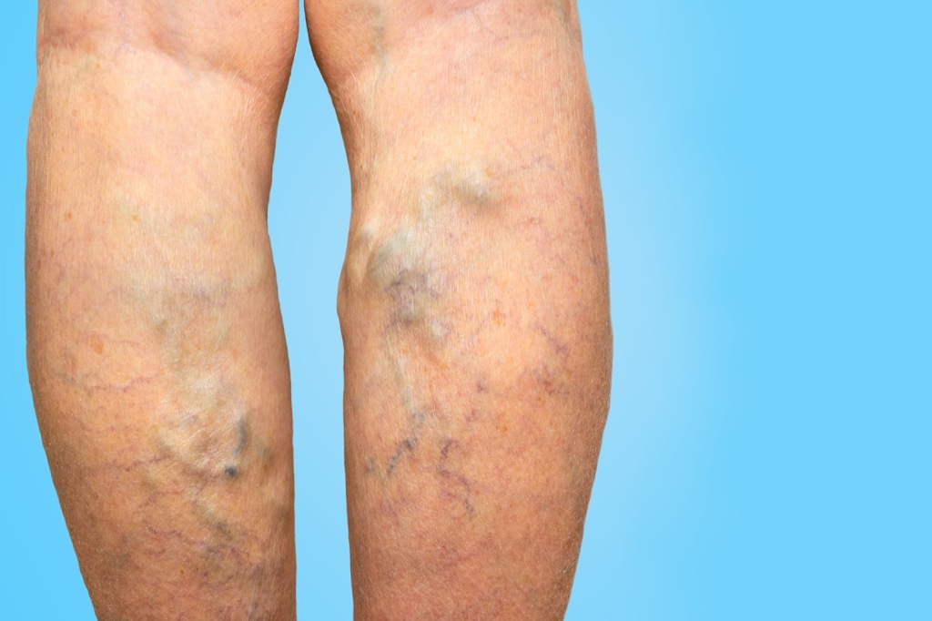 varicose veins
