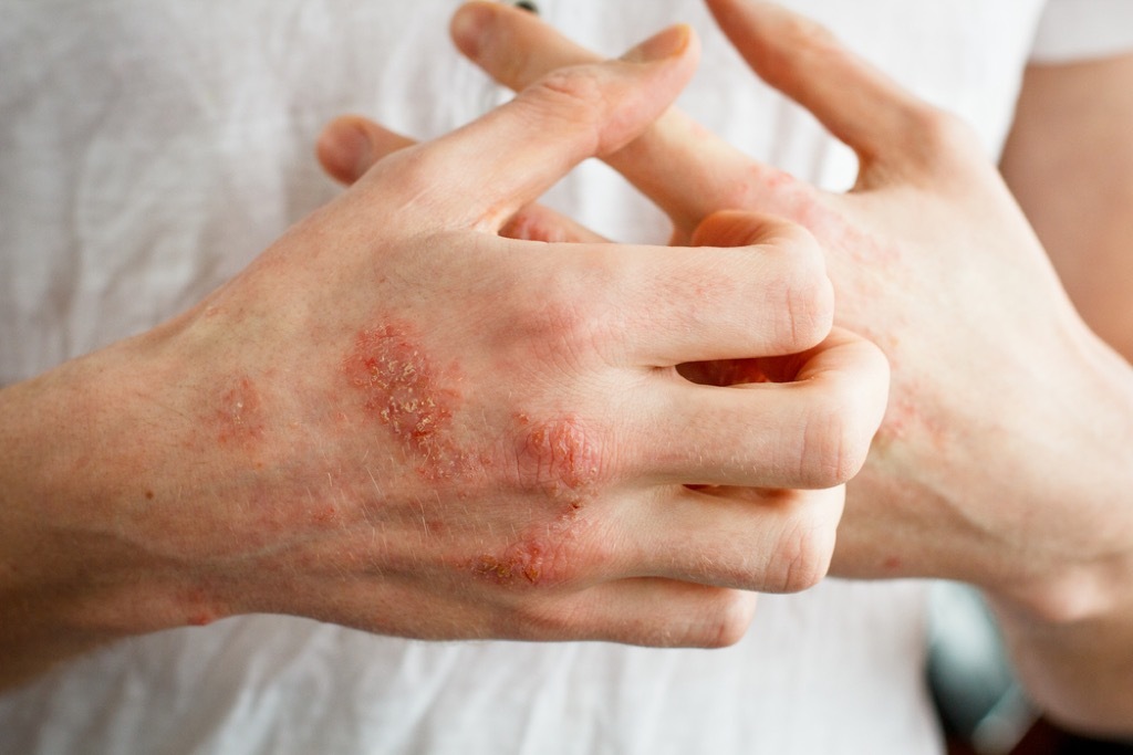 eczema
